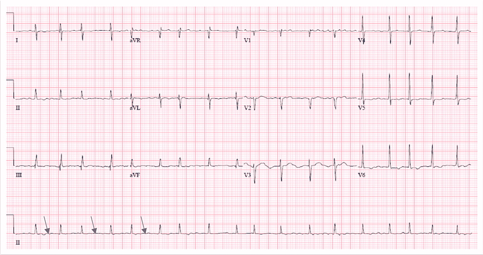 Electrocardiogram-with-blue-arrows-showing-the-fibrillary-wave-(see-in-atrial-fibrillation)-with-a-rapid-ventricular-rate-of-108-beats-per-minute,-with-no-significant-ST-T-wave-changes