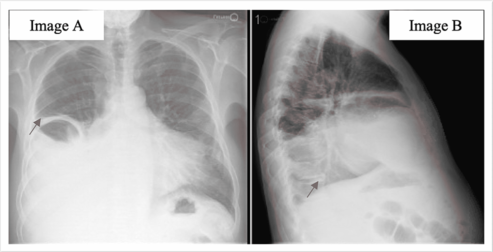 X-ray-chest-with-red-arrows-in-panels-A-and-B-showing-large-right-pleural-effusion-with-concerns-for-consolidation-vs.-atelectasis-secondary-to-the-effusion-of-the-right-lung-base