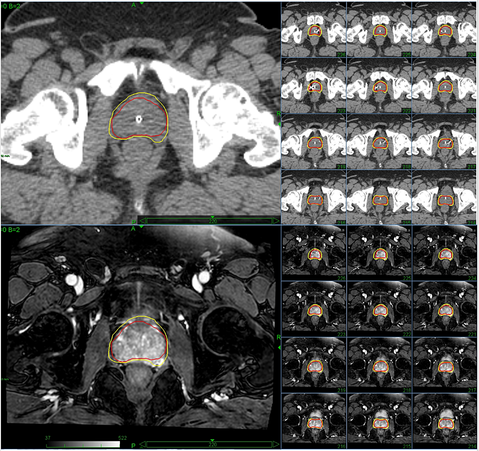 Cureus Stereotactic Body Radiation Therapy For Prostate Cancer An Institutional Experience 0018