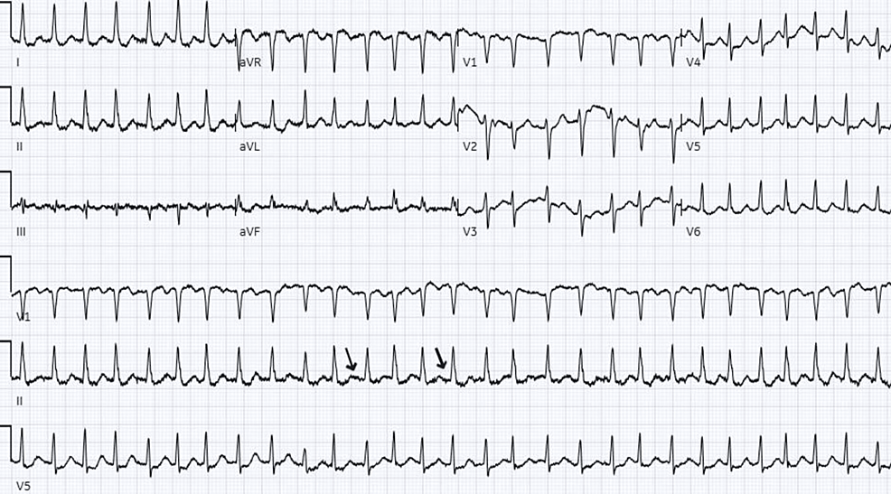 EKG-on-the-sixth-day-of-admission-showed-an-irregularly-irregular-rhythm-with-the-absence-of-P-waves-(black-arrows)-and-a-ventricular-rate-of-175-beats-per-minute.-The-findings-are-suggestive-of-atrial-fibrillation-with-a-rapid-ventricular-response.