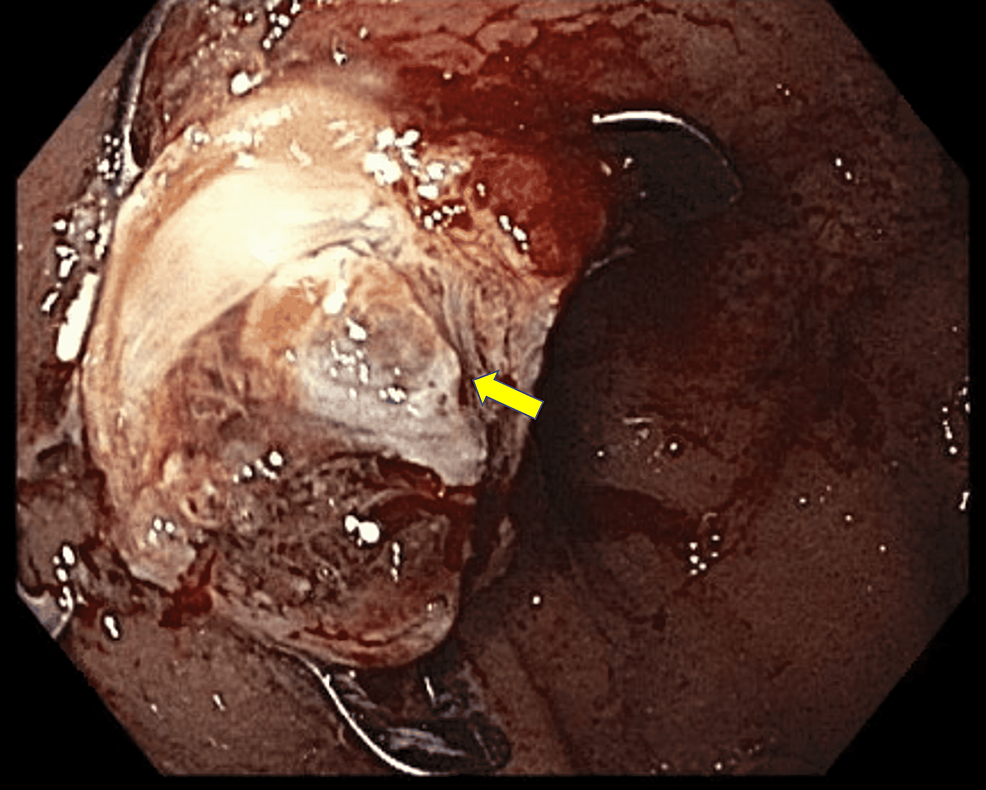 Full-thickness-resection-of-lesion-with-the-FTRD®-system