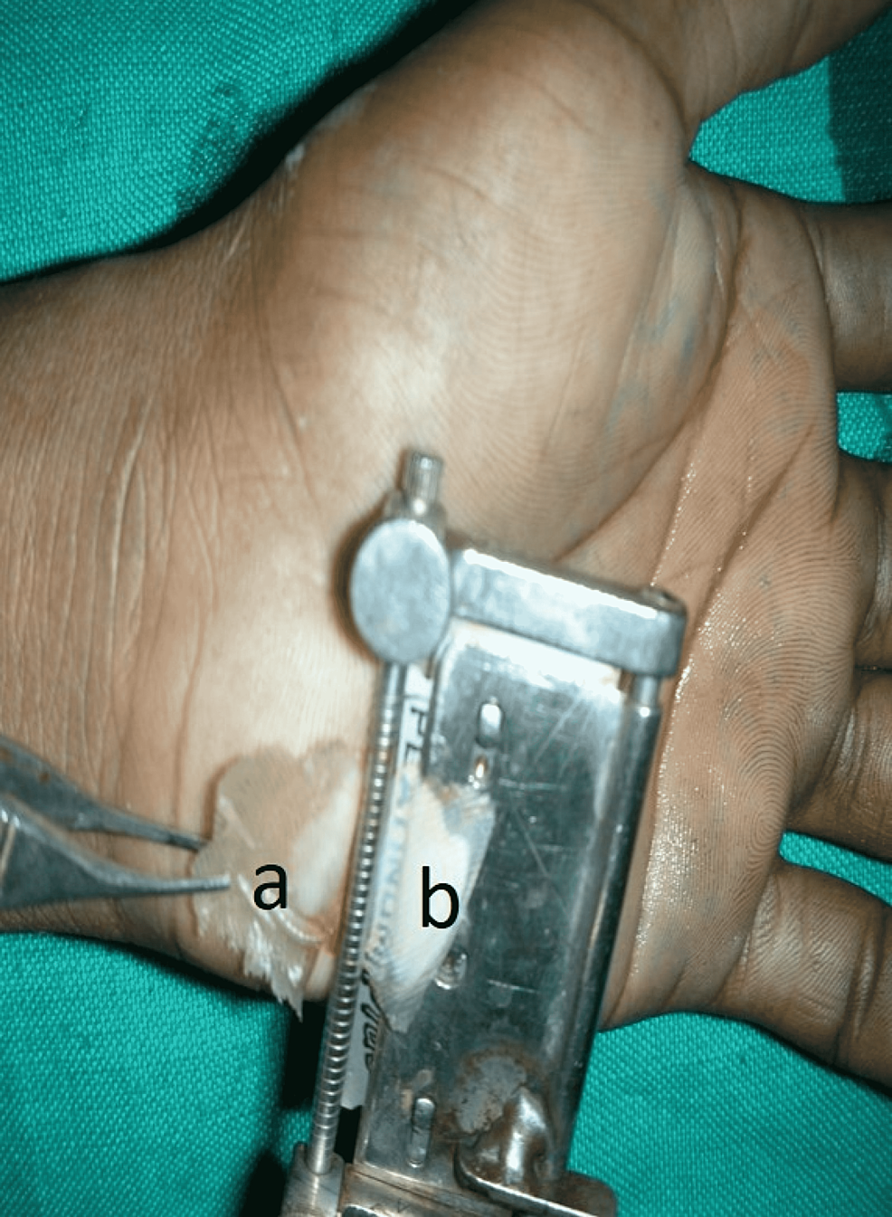 Split Nail Deformity - Hand - Orthobullets