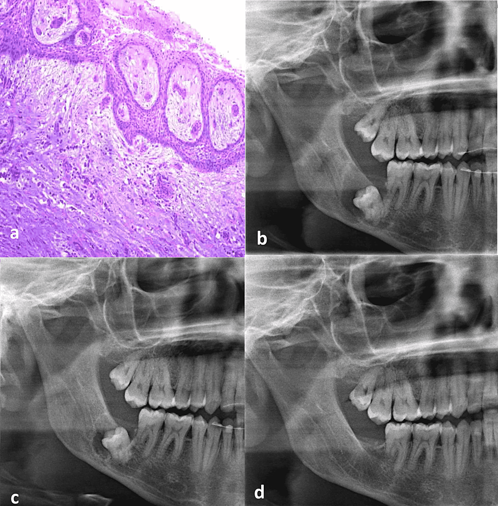 Cureus Marsupialization Of Dentigerous Cysts Followed By Enucleation