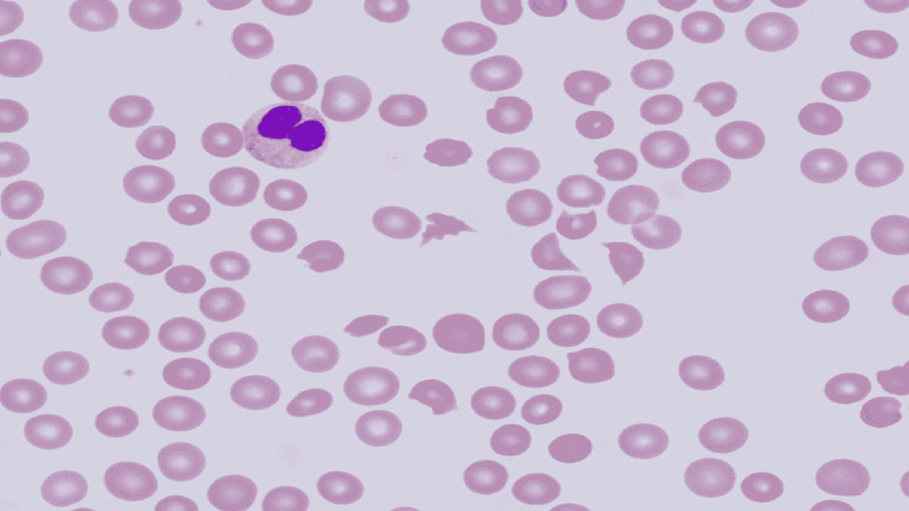 Cureus | Thrombotic Thrombocytopenic Purpura: A Rare Cause of Severe Acute  Kidney Injury