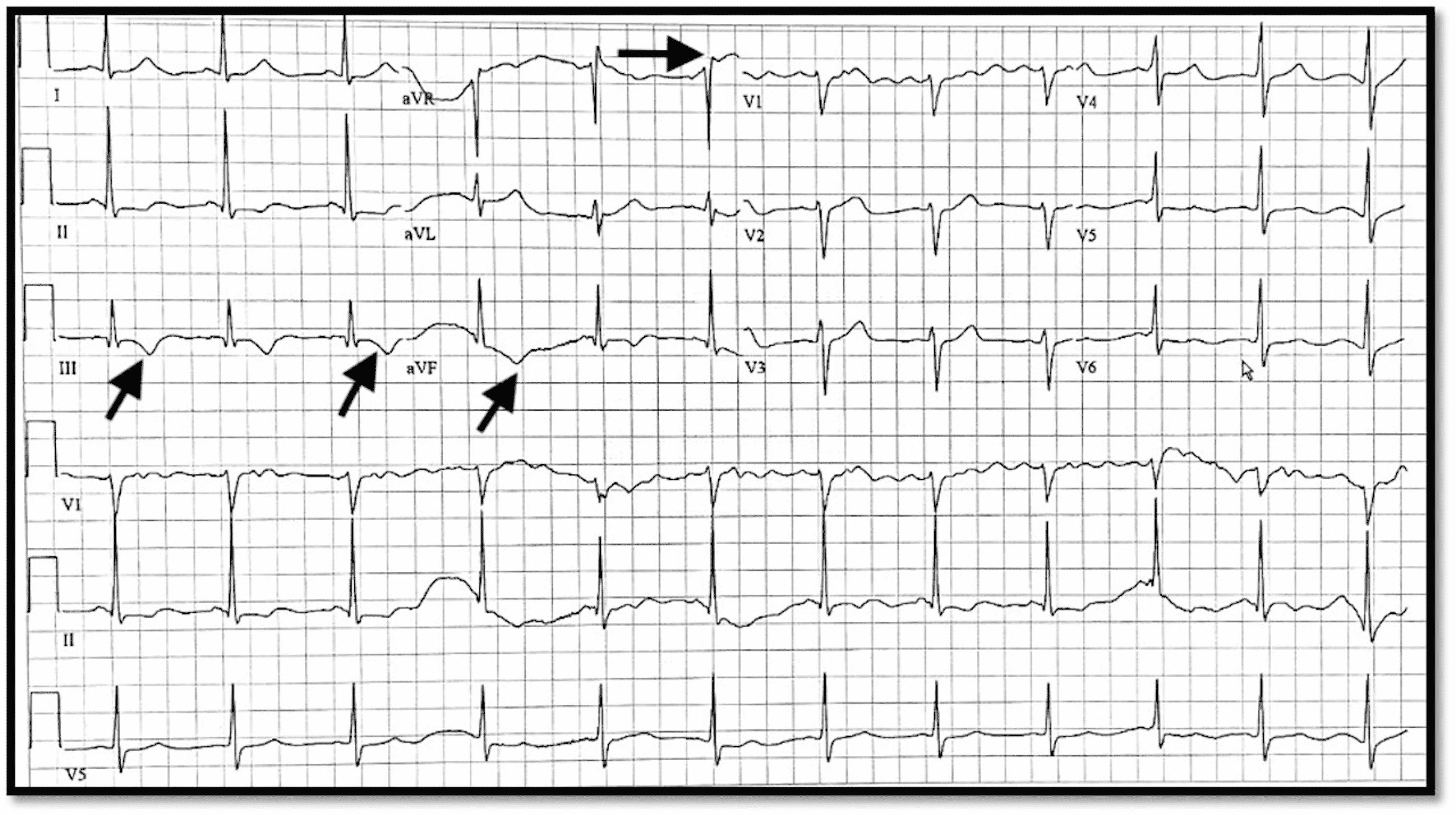 Cureus | Coronary Vasospasm Associated With Synthetic Marijuana ...