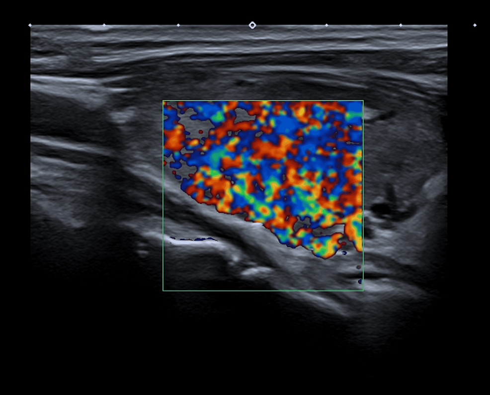 Thyroid-ultrasonography-with-doppler