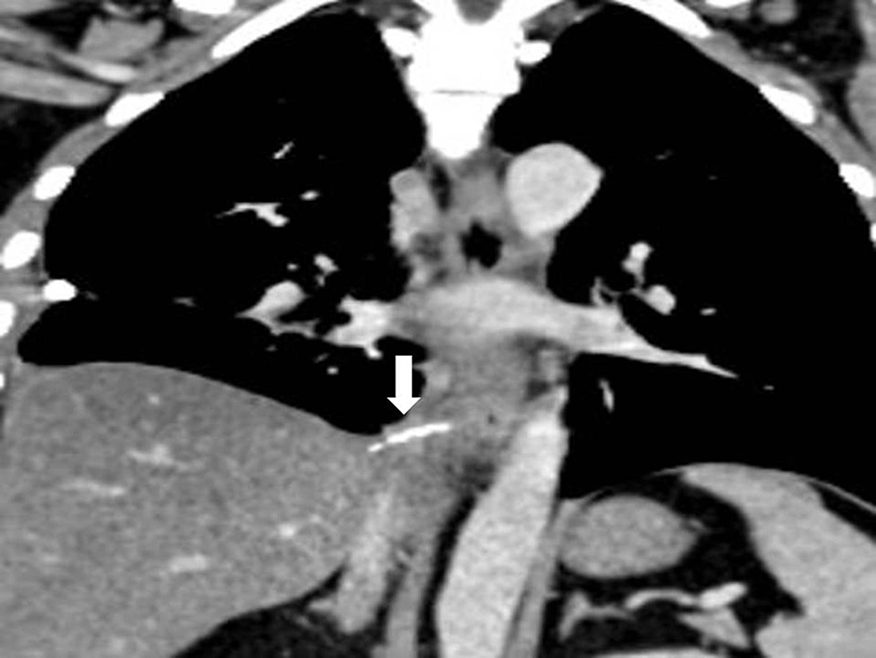 Cureus Laparoscopic Removal of an Ingested Foreign Body with