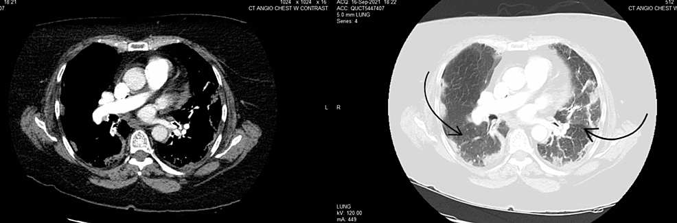 CT-angiogram:-bilateral-multifocal-pneumonia-(black-arrows)-with-no-evidence-of-acute-pulmonary-embolism.
