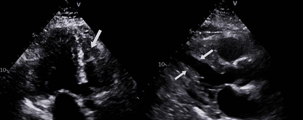 -Echocardiogram-findings-(white-arrows)-suggestive-of-mildly-increased-left-ventricular-wall-thickness-with-preserved-left-ventricular-ejection-fraction-(LVEF)-and-a-normal-right-ventricular-systolic-function.