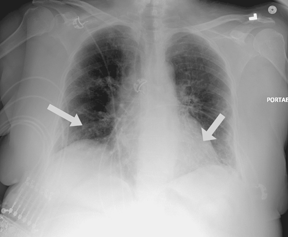 Chest-x-ray:-bilateral-patchy-opacities-(white-arrows)-consistent-with-COVID-19-pneumonia.