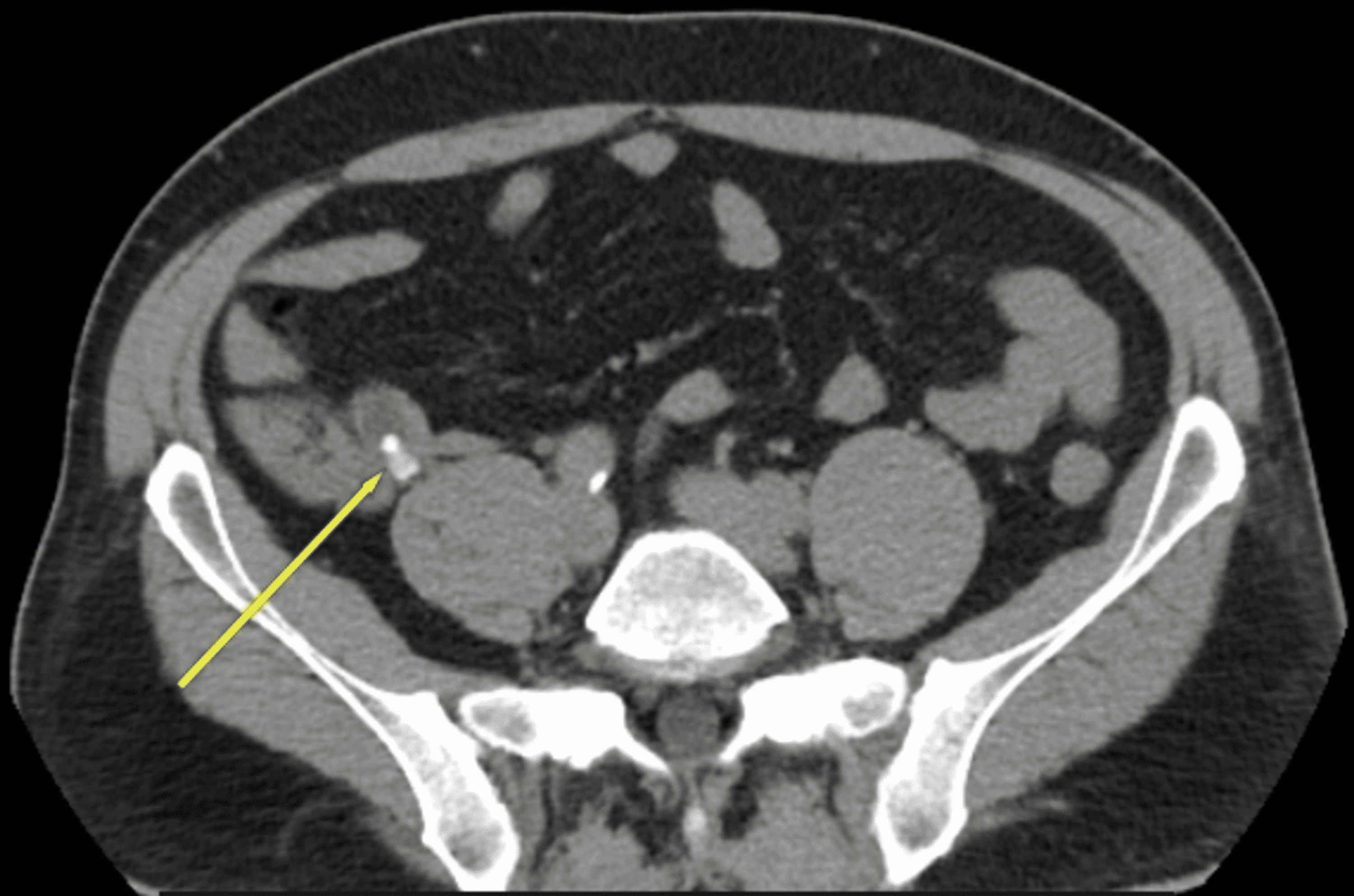 Cureus | Superinfection Of An Obstructive Appendiceal Mucocele: A Case ...