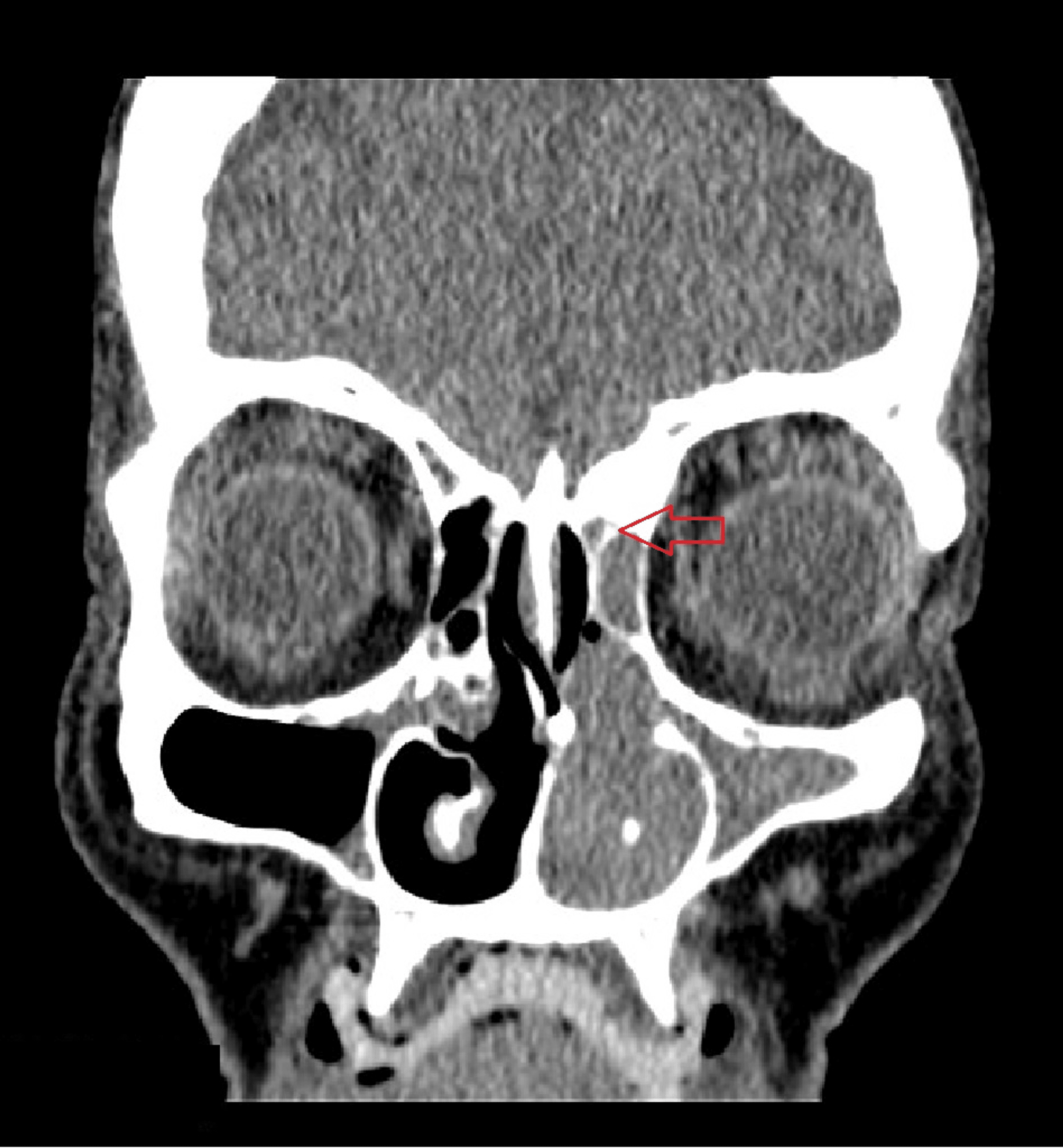 Cureus | Sinonasal Malignant Melanoma Variant: A Case Report