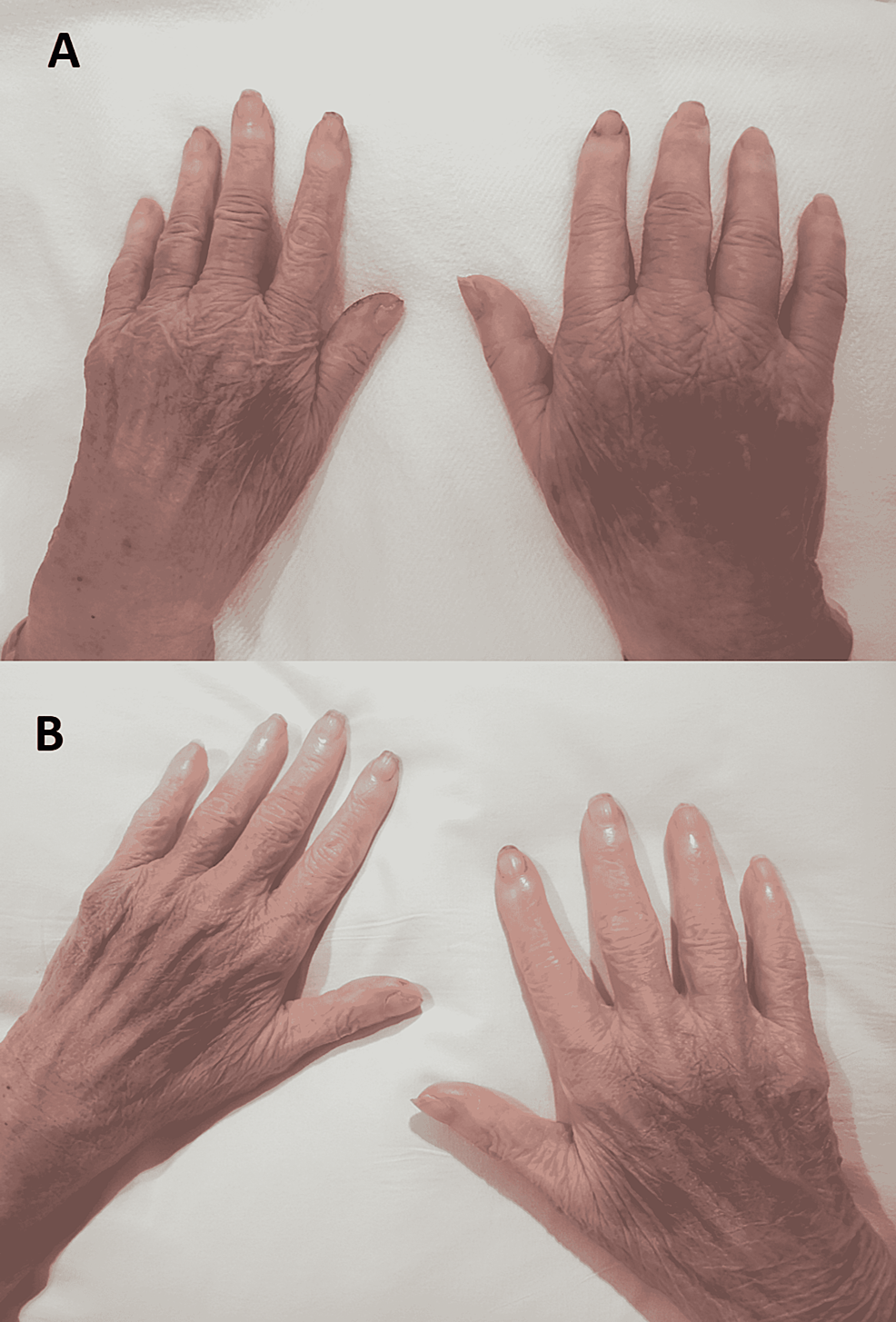 Cureus Purple Glove Syndrome Recognizing a Rare Complication of