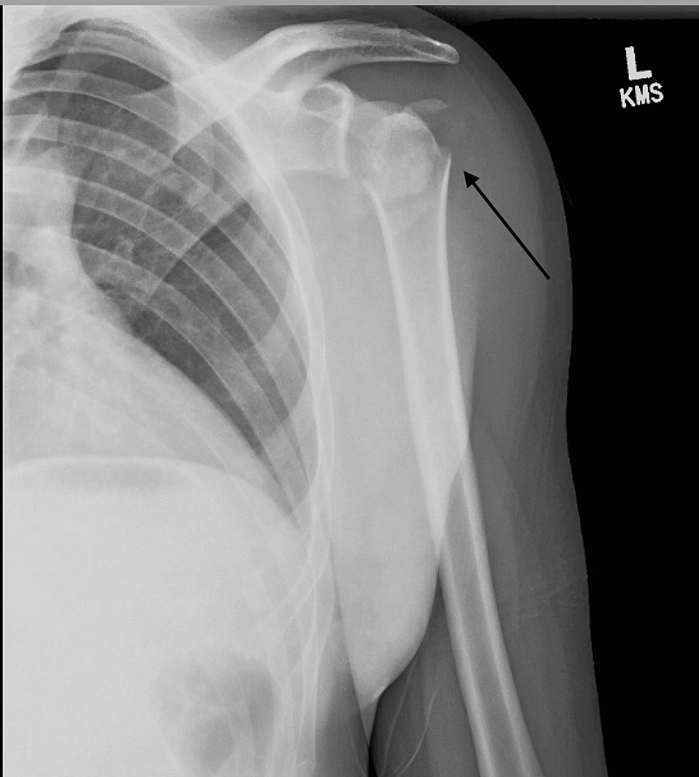 Cureus | An Irreducible Posterior Fracture-Dislocation of the 