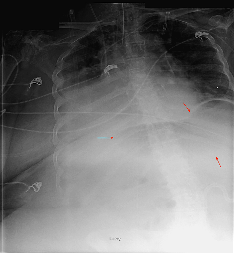 Cureus | Jejunal-Ileal Diverticulosis Induced Witzel Tube Failure: A ...