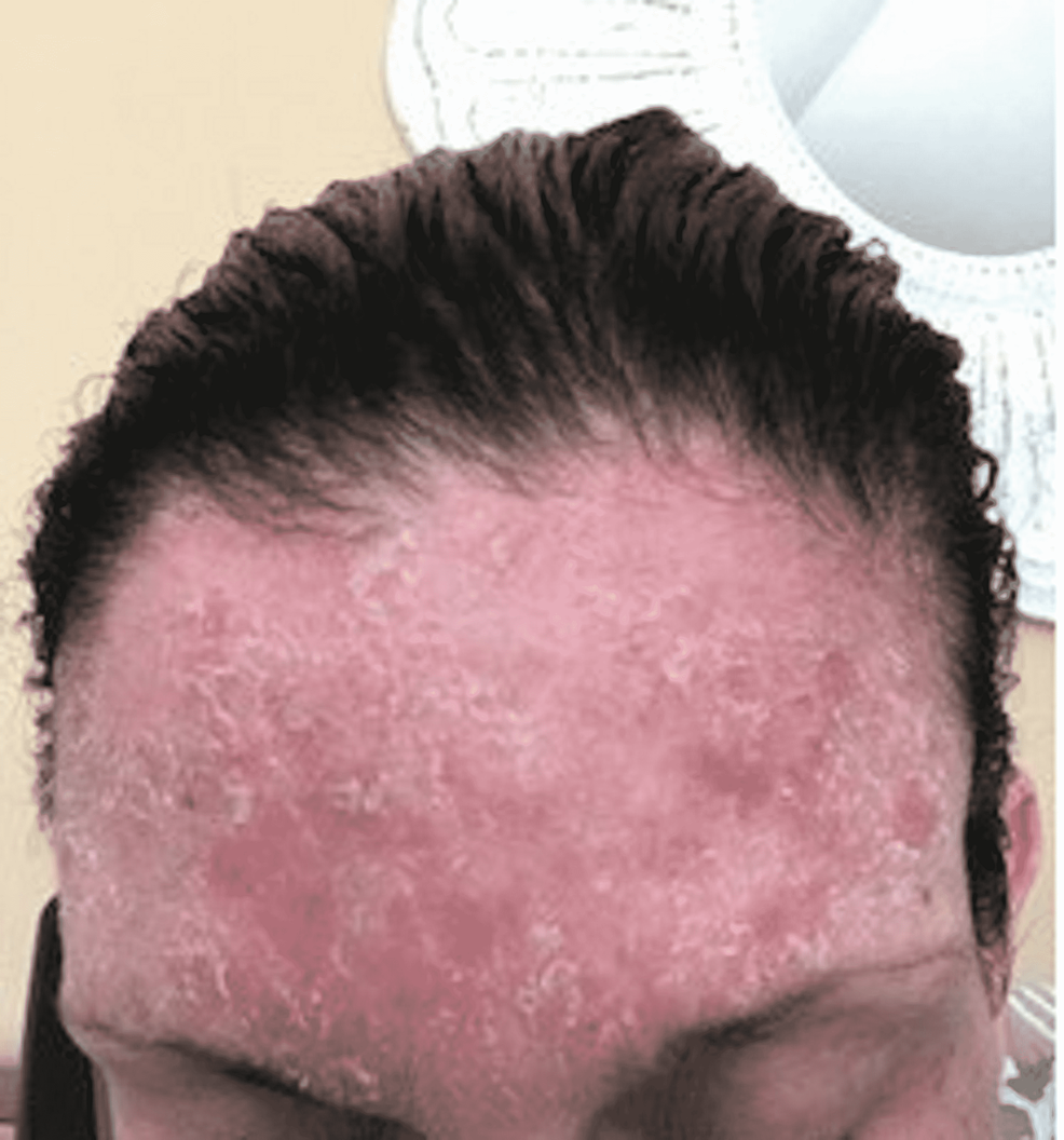 Forehead-contact-dermatitis-rash