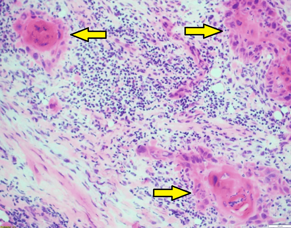 Thin-rim-of-cuboidal-cells-abruptly-transitioning-to-an-eosinophilic,-parakeratotic-core,-resembling-"fried-eggs"-(H&E,-100x).