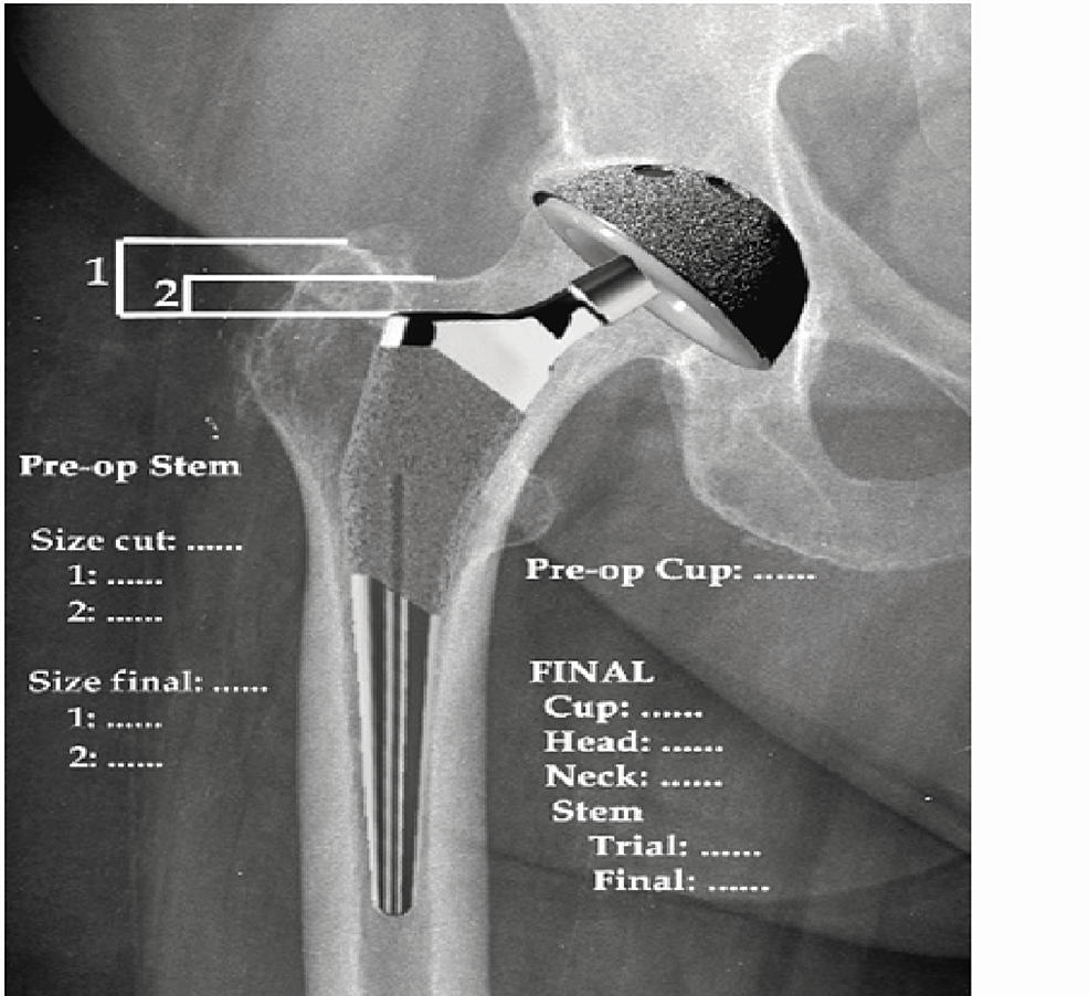 Cureus, MINIMA Short Stem Versus Standard Profemur (TL) Stem in Primary Total  Hip Replacement: A Comparative Study