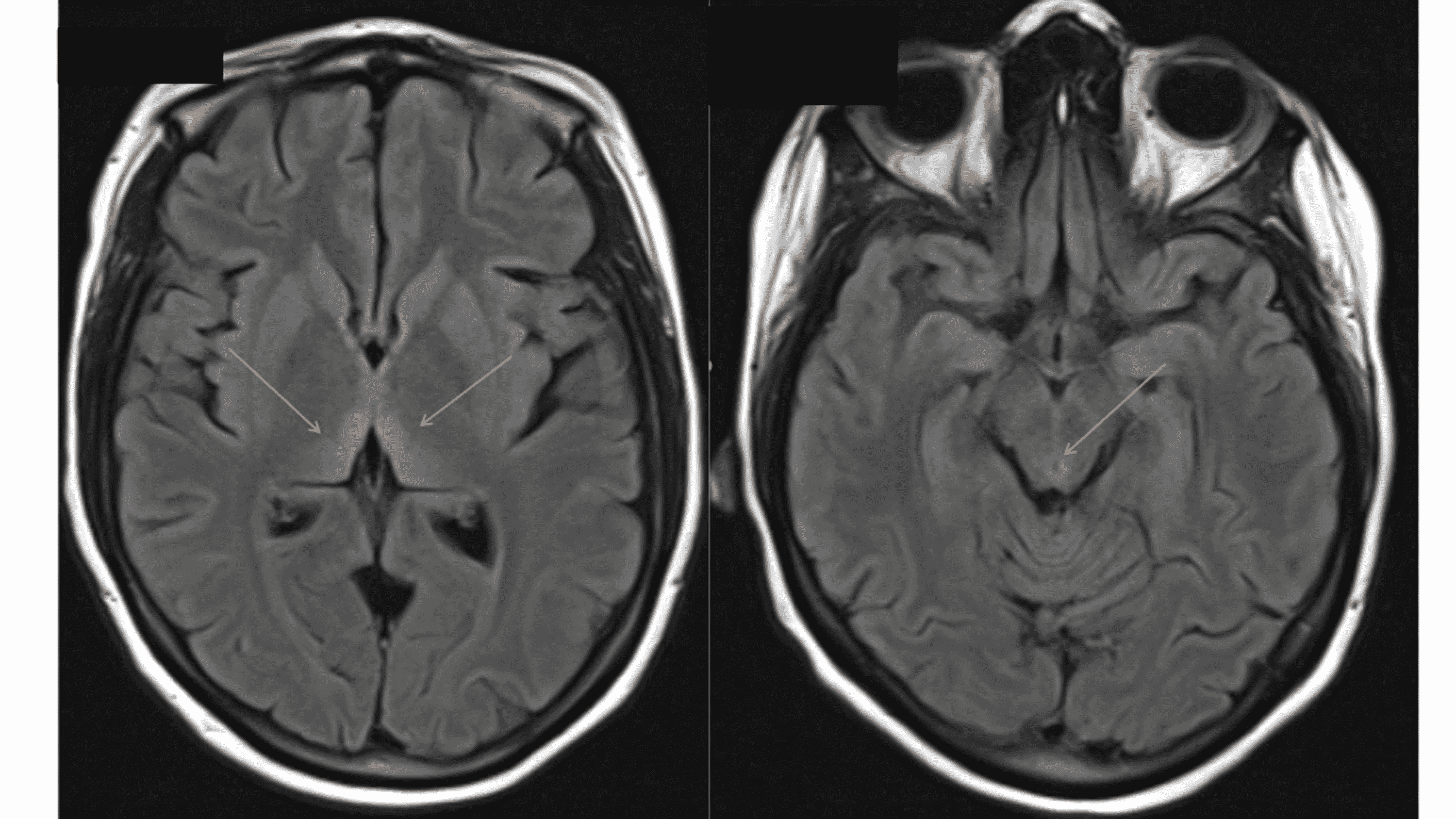 Cureus Hyperemesis Gravidarum Complicated By Wernickes Encephalopathy A Case Report 6024