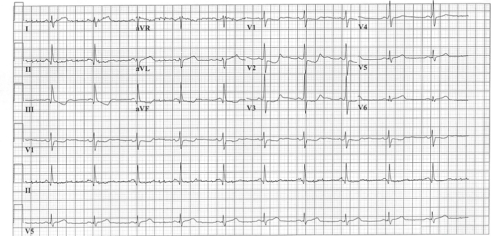 Cureus | Energy Drinks and Myocardial Infarction