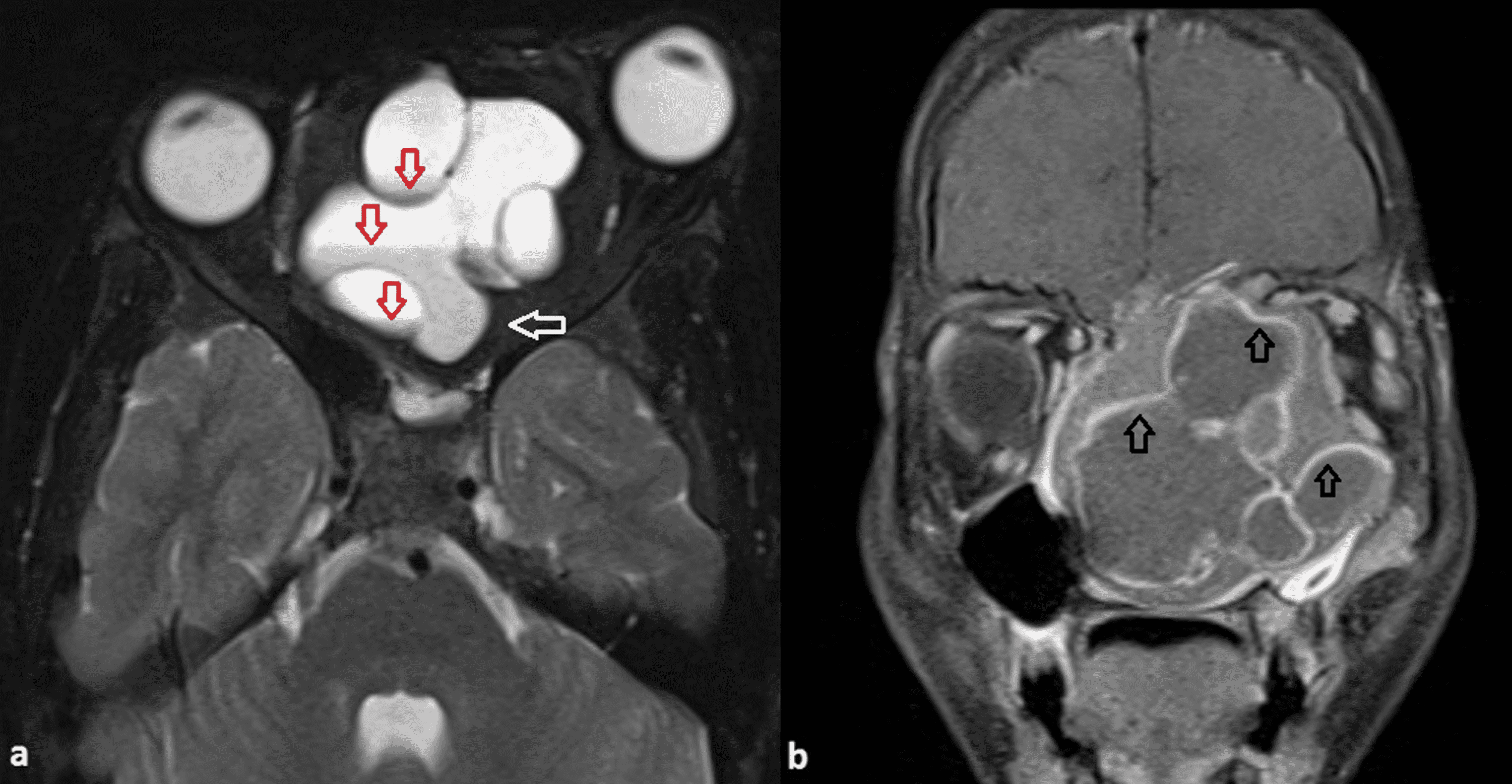 Cureus Fibrous Dysplasia With Aneurysmal Bone Cyst Presenting As Sinonasal Mass 2597