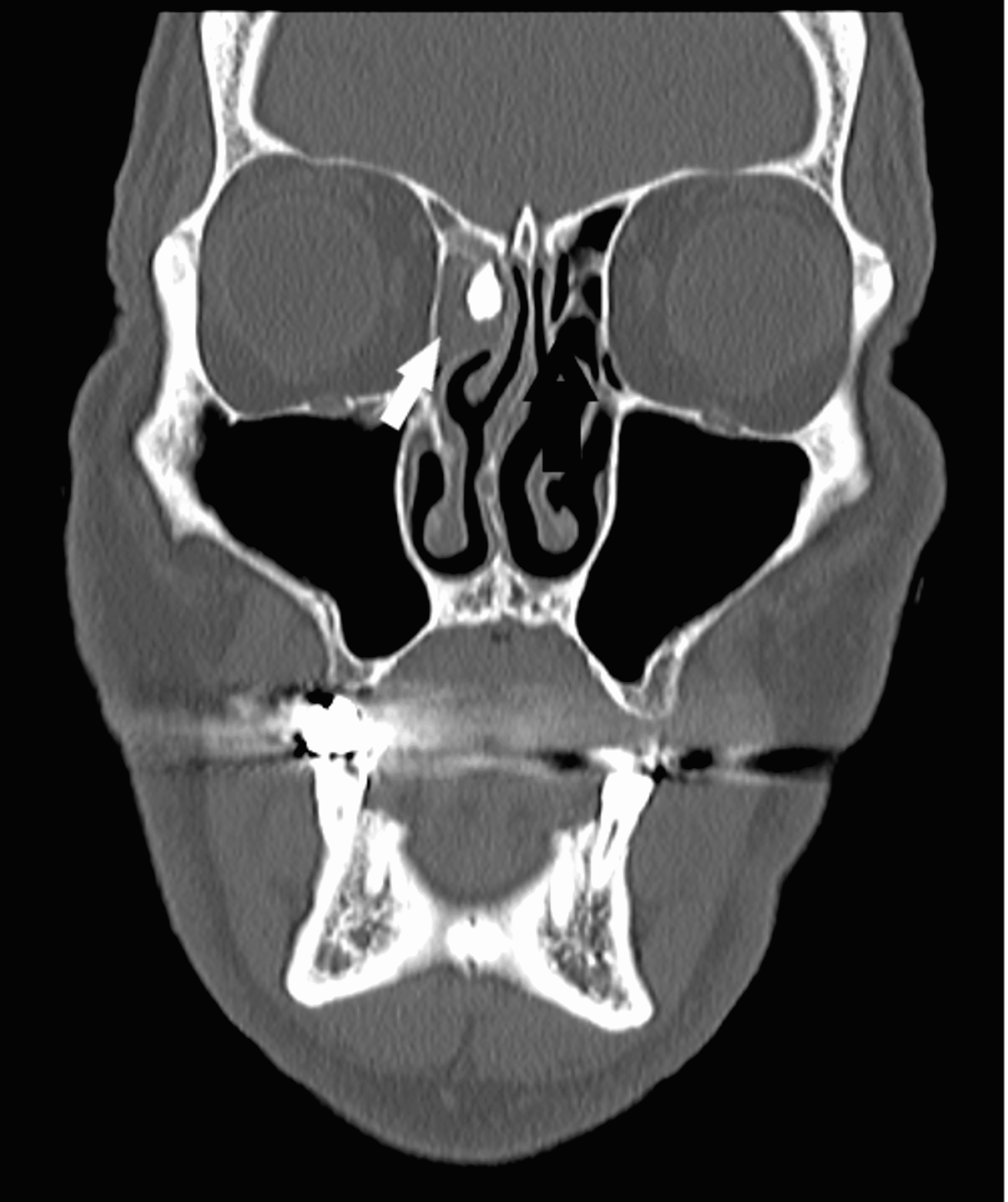 Cureus | Endoscopic-Assisted Removal of a Retained Foreign Body From Frontal Sinus | Article