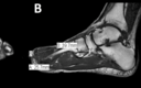 Cureus | A Case of a Second Intermetatarsal Space Gouty Tophus with a ...