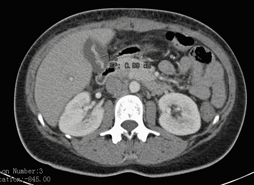 Computerized-tomography-scan-of-the-patient’s-abdomen-revealed-a-9-mm-thickening-of-the-gallbladder-wall-on-admission,-consistent-with-gallbladder-inflammation-(arrow).