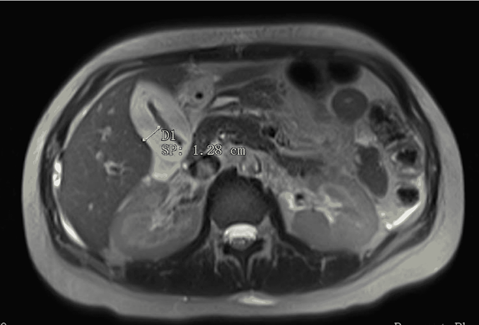 Magnetic-resonance-cholangiopancreatography-of-the-patient’s-abdomen-revealed-a-1.28-cm-thickening-of-the-gallbladder-wall-(arrow),-consistent-with-gallbladder-inflammation.