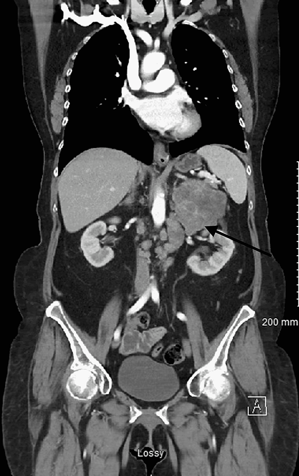 Computer-tomography-image-of-chest/abdomen/pelvis-showing-adrenal-mass-on-coronal-plane