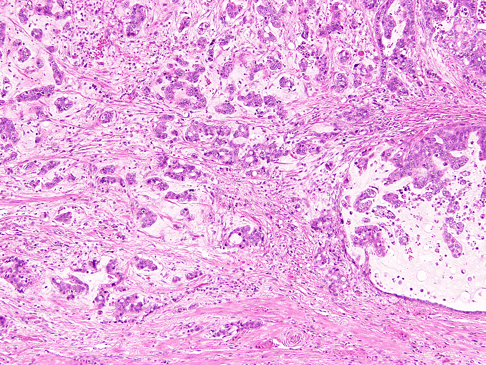 Pathological-findings-of-the-tumor-showed-a-well-differentiated-adenocarcinoma- (hematoxylin-and-eosin-200x).