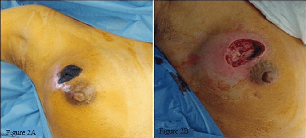 Clinical-and-perioperative-appearance-of-the-wound