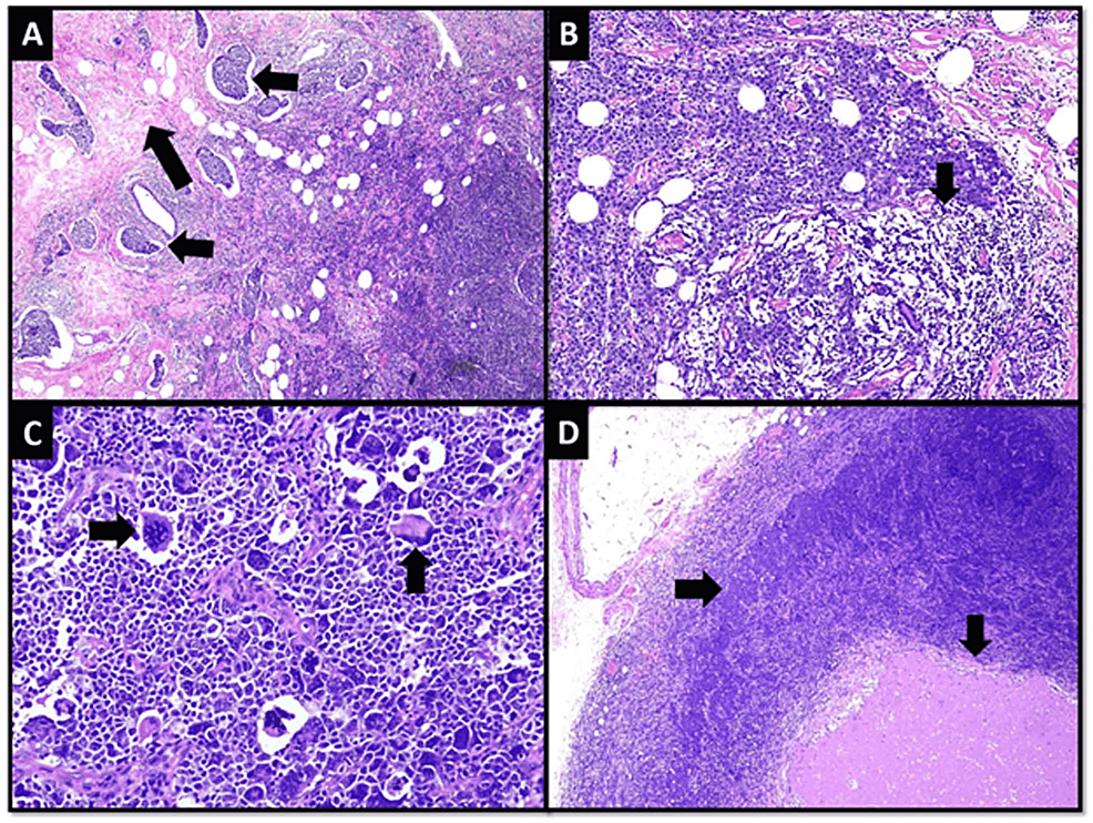 Microscopic-features-of-the-tumor-in-MRM-specimen