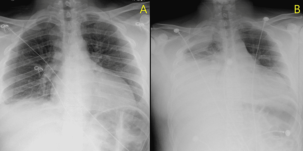 pneumothorax vape Viral Tweet Blames Vaping for Collapsed Lung, but It's Not That Simple main image 0
