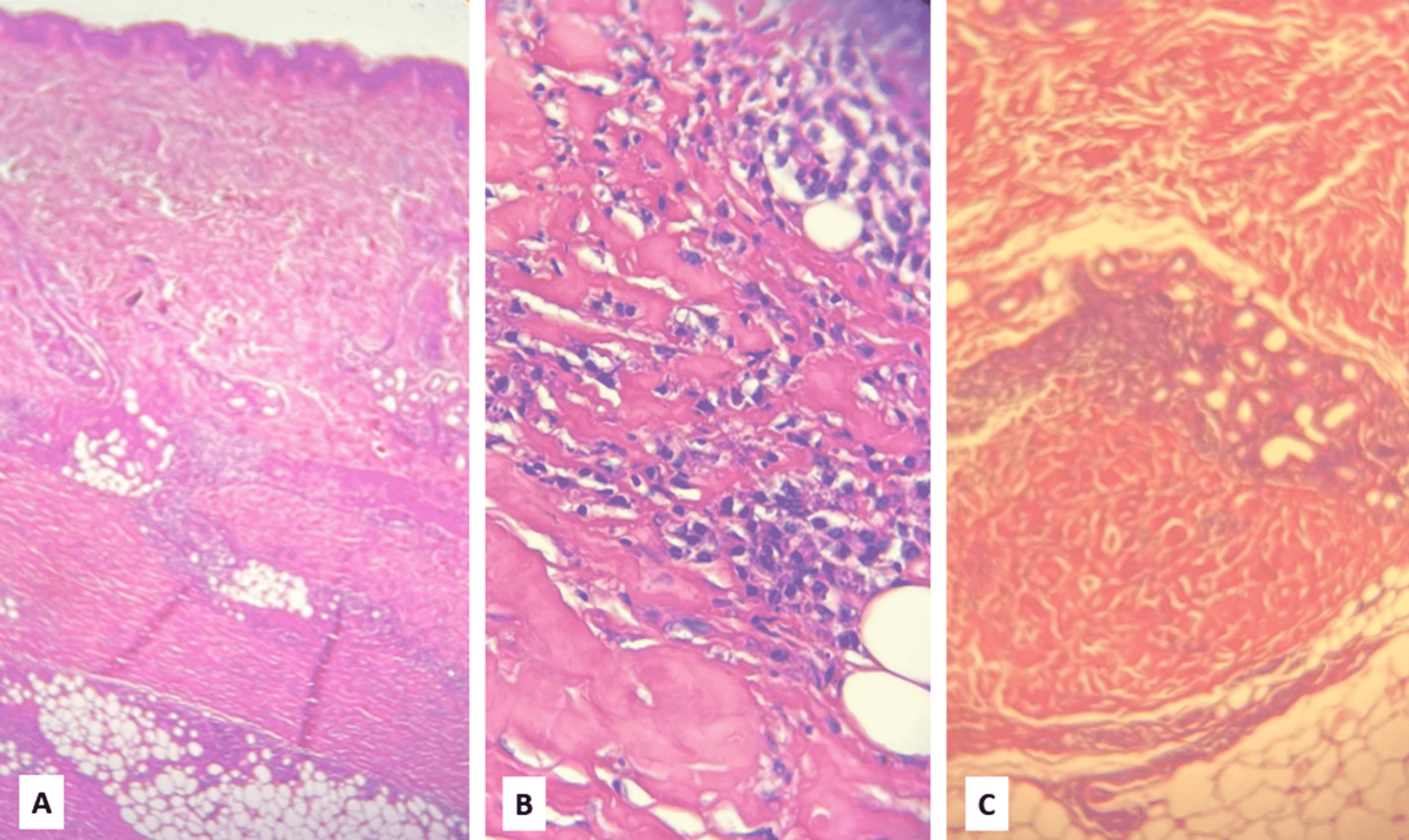 Cureus Eosinophilic Fasciitis And Smoldering Multiple Myeloma An