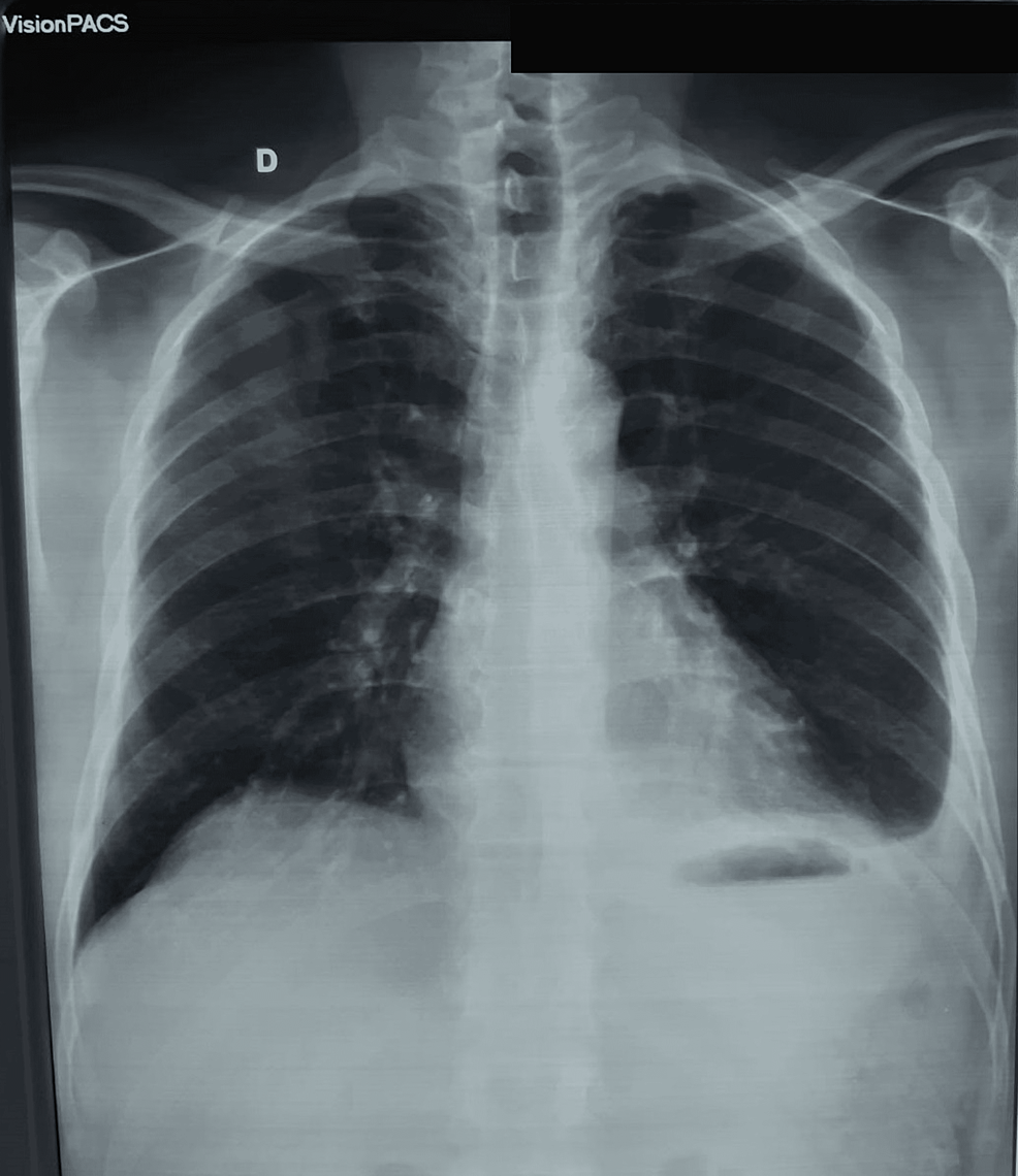 Chest-x-ray-showing-mild-unilateral-left-pleural-effusion