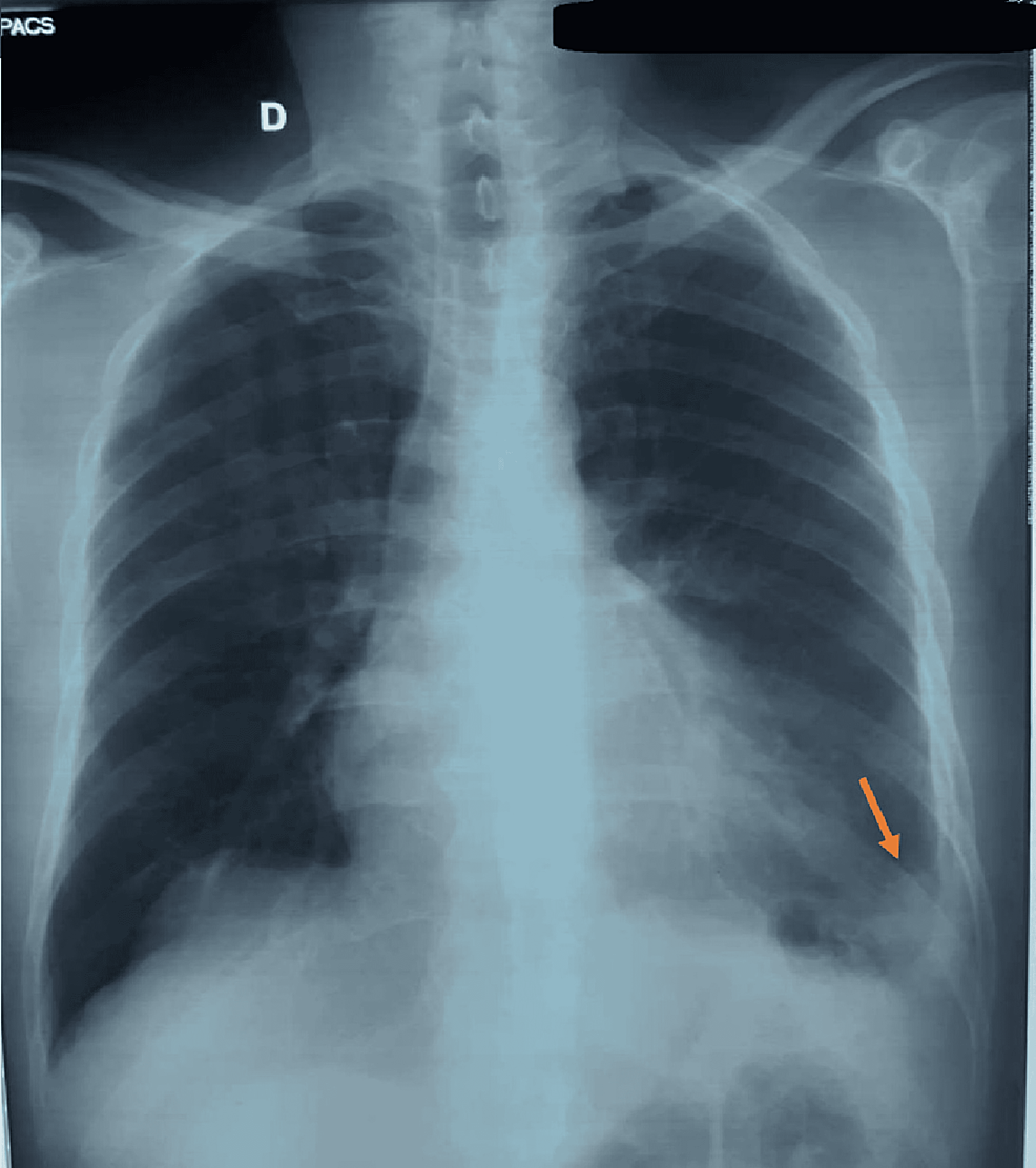 Left-basal-consolidation-with-a-minimal-left-pleural-effusion