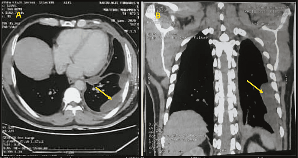 Axial-(A)-and-coronal-(B)-view--of-CT-chest-with-contrast-showing-left-nodular-thickening-of-the-pleura-(yellow-arrows)