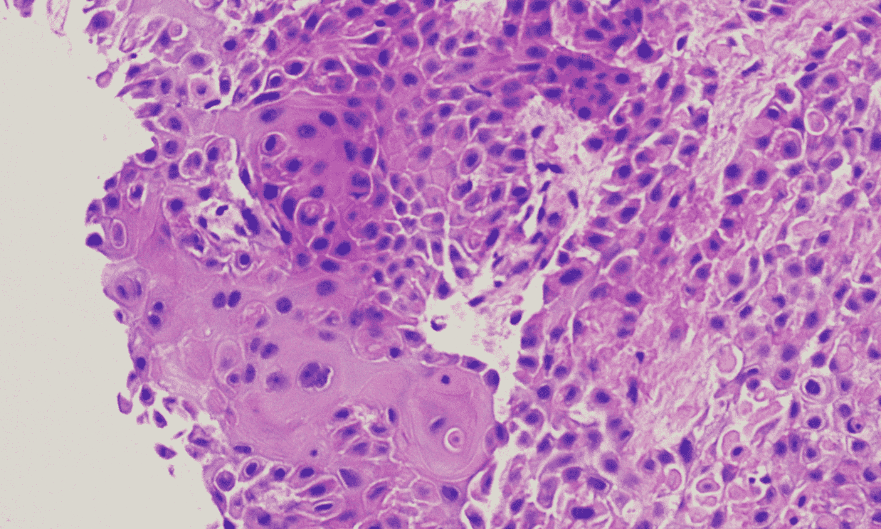 Cureus | Pericardial Metastasis From Recurrent Squamous Cell Carcinoma ...