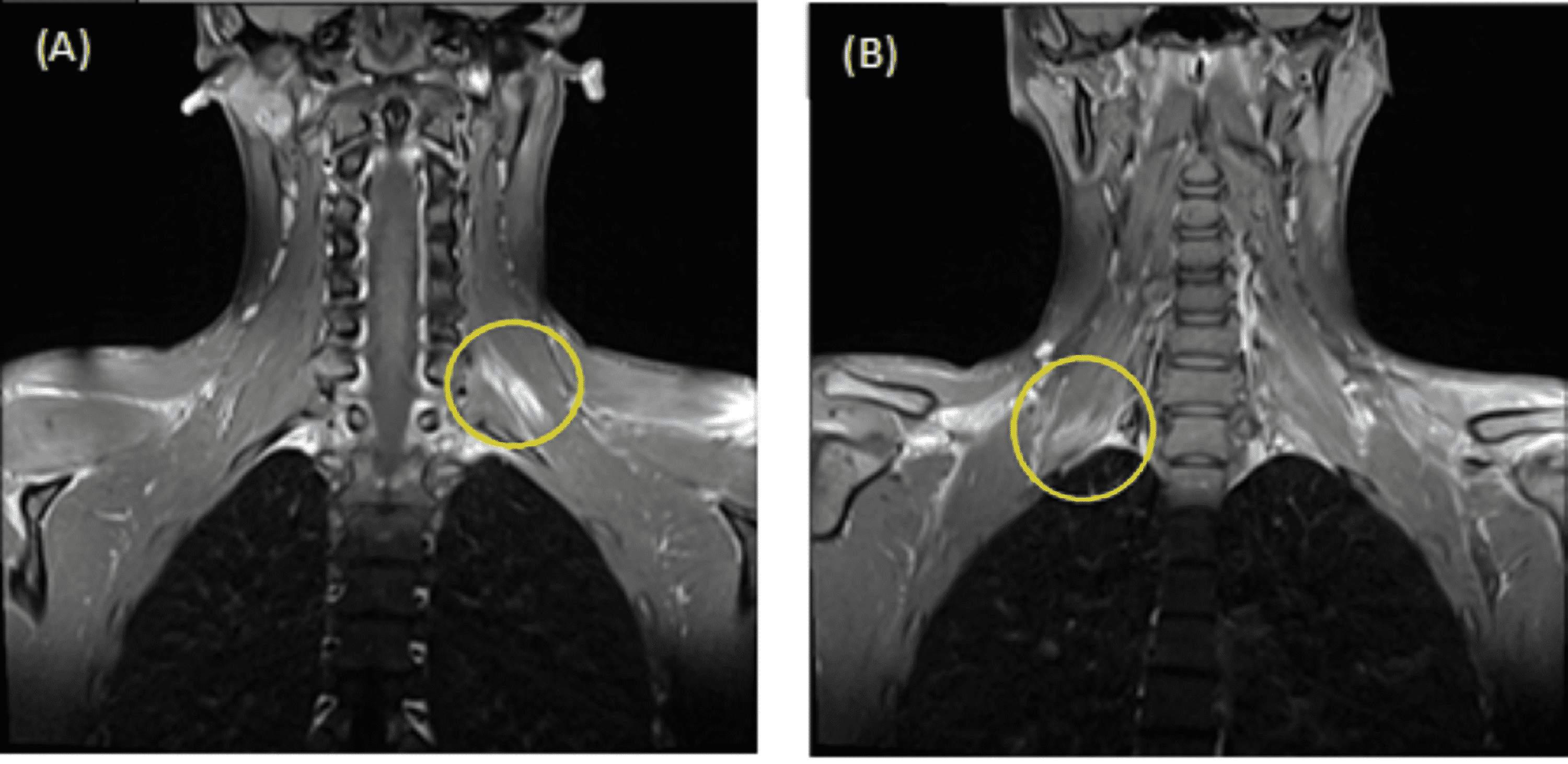 brachial plexus injury mri