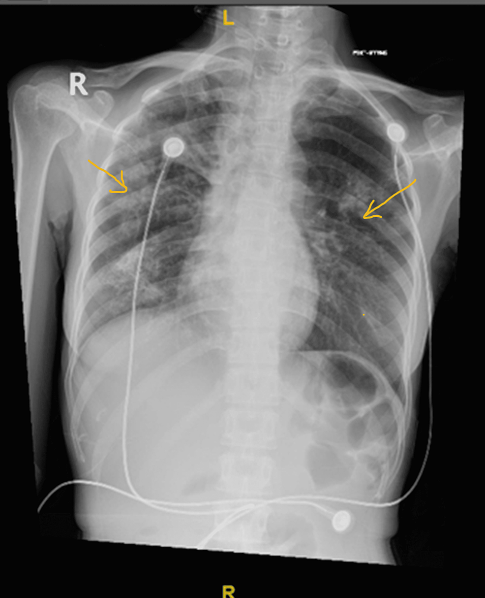 Bilateral-inhomogeneous-faint-lung-opacities,-the-early-consolidative-process-likely-of-inflammatory-origin