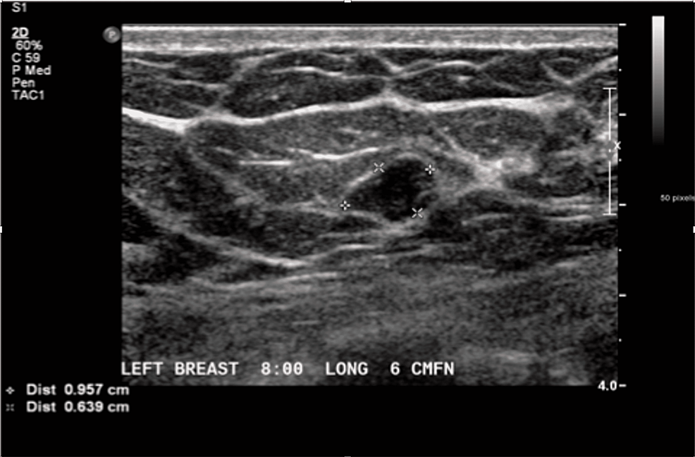 Fibroepithelial Lesion Spectrum A Case Report Documenting a Possible Transformation to a