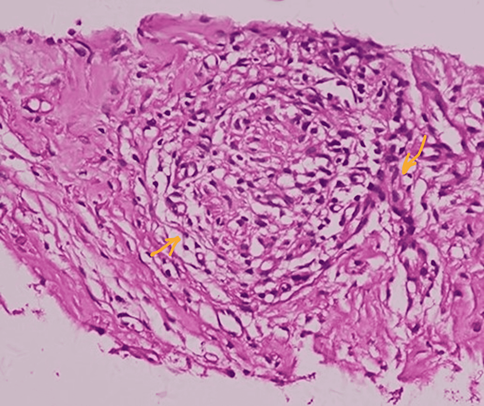 Histopathological-presentation-of-the-specimen-sections-revealed-appendiceal-tissue-showing-chronic-inflammatory-cellular-reaction-and-few-granulomas-in-serosa-and-fatty-tissue.-Lymphoid-follicular-hyperplasia-is-observed-