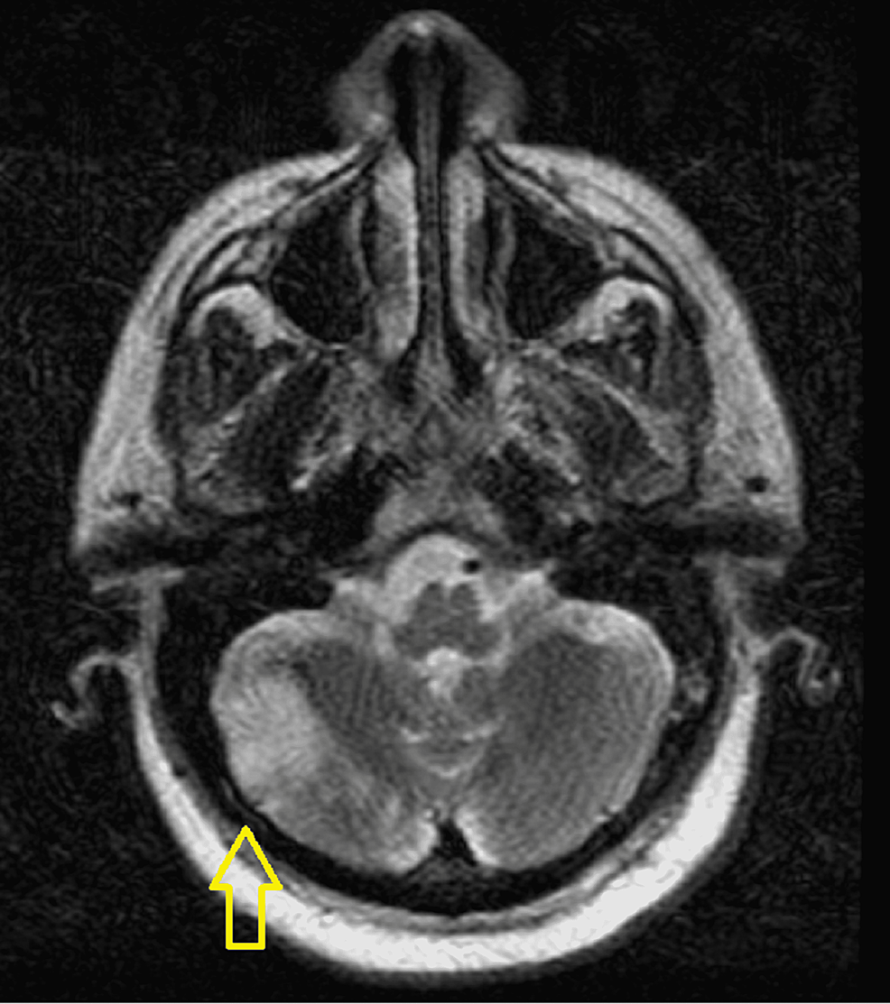 MRI-of-the-brain-showing-right-sided-cerebellar-infarct.