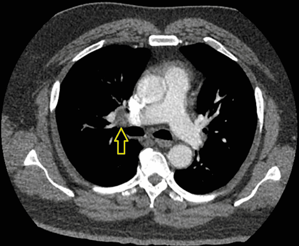 CT-imaging-showing-a-right-lower-lobe-segmental-pulmonary-artery-embolism.