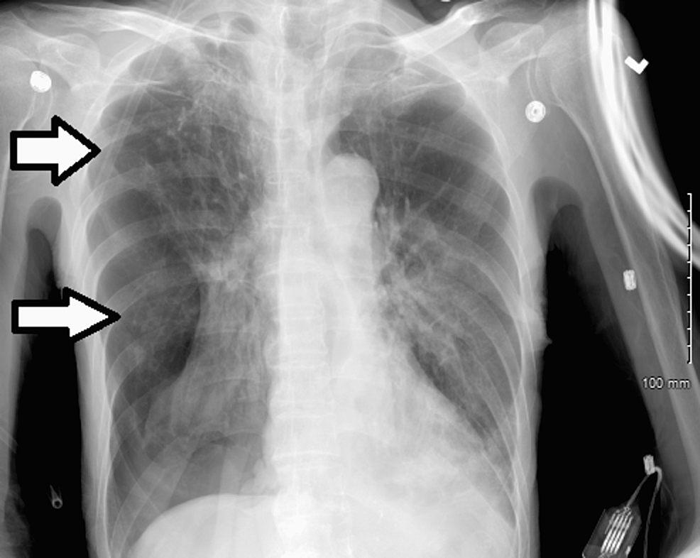 Chest-X-ray-showing-lucency-in-the-mid-and-lower-right-lung-fields-suggesting-pneumothorax-(white-arrows).
