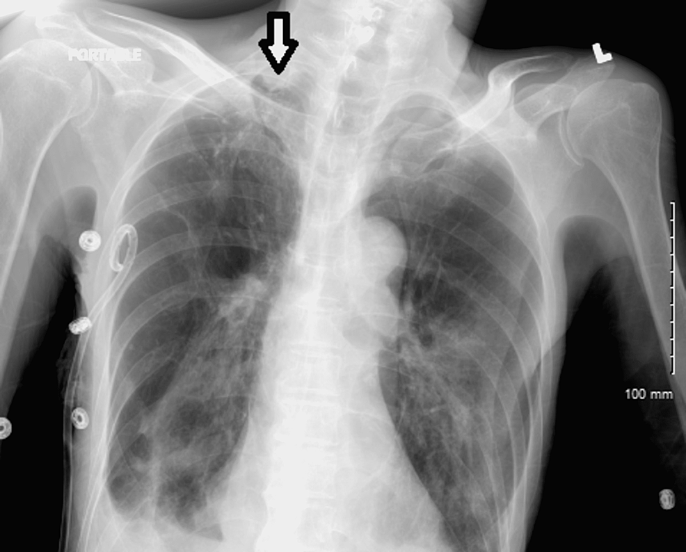 The-chest-X-ray-indicates-a-small-right-apical-pneumothorax-(white-arrow).