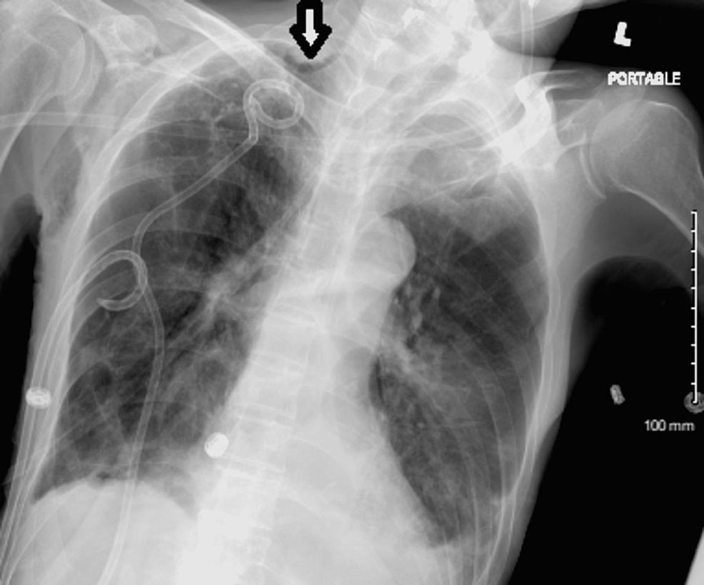 Follow-up-chest-X-ray-after-apical-chest-tube-insertion:-No-evidence-of-gross-pneumothorax,-but-a-stable-small-right-apical-pneumothorax-can-be-appreciated-(white-arrow).