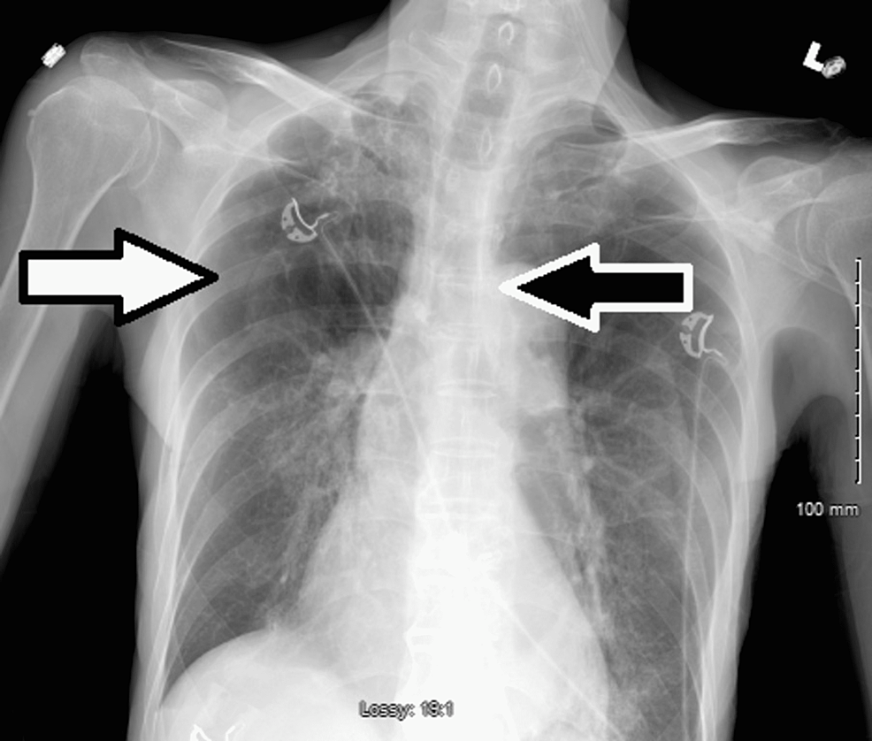 Chest-X-ray-obtained-after-apical-chest-tube-removal,-large-right-sided-pneumothorax-(white-arrow)-with-flattening-of-the-right-mediastinal-structures-and-mediastinal-shift-to-the-left-(black-arrow).-Findings-suggestive-of-tension-pneumothorax.