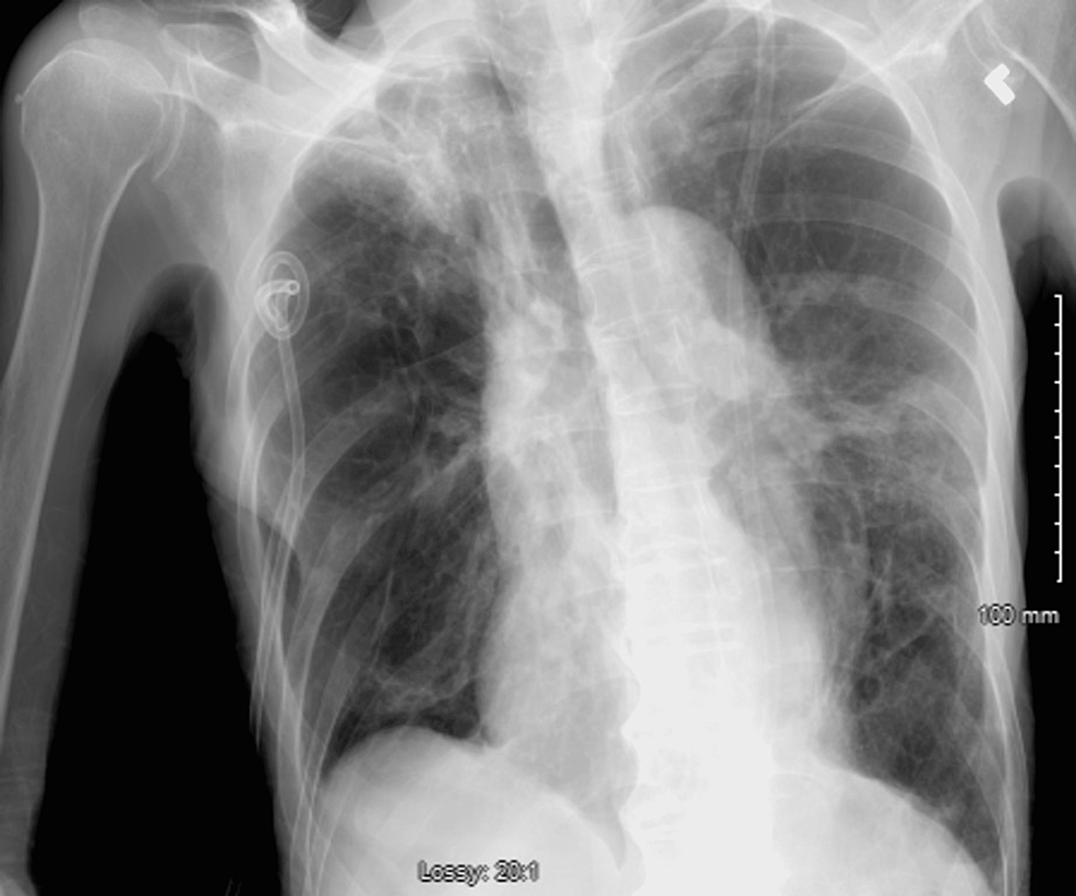 Chest-X-ray-obtained-after-reinsertion-of-the-apical-chest-tube-showed-no-large-pneumothorax-and-resolution-of-the-tension-pneumothorax.